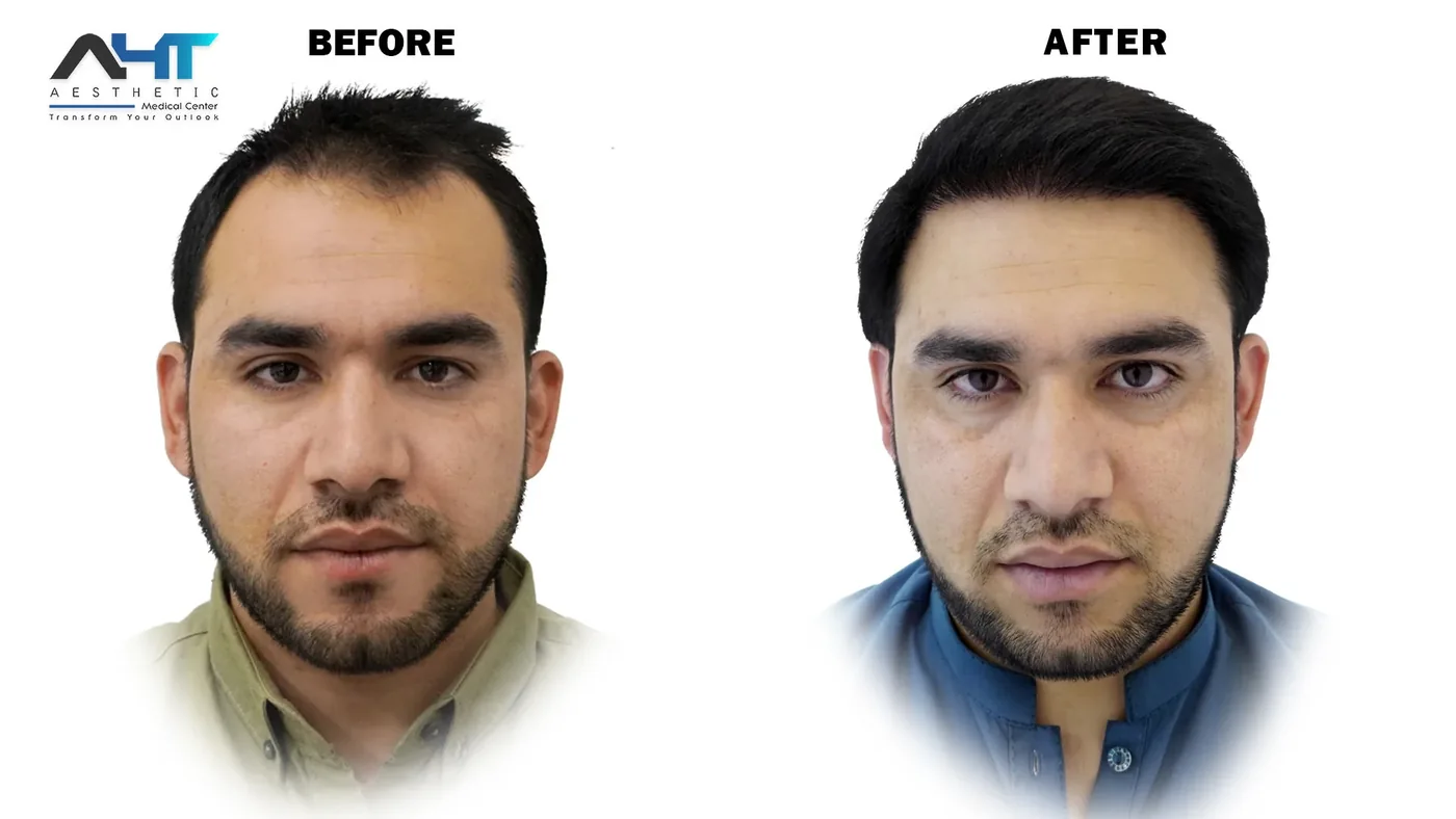 AHT Patient Result 2 before and after