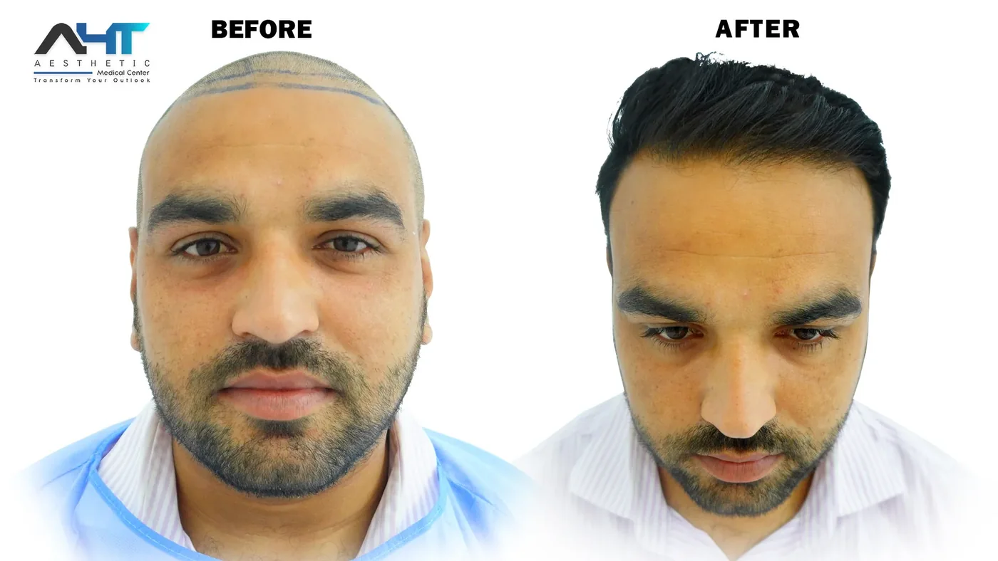 AHT Patient Result 3 before and after