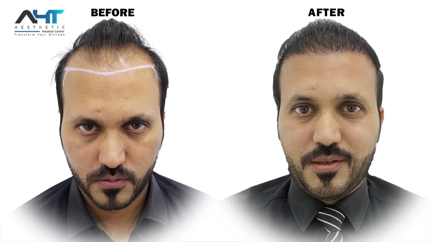 AHT Patient Result 7 before and after