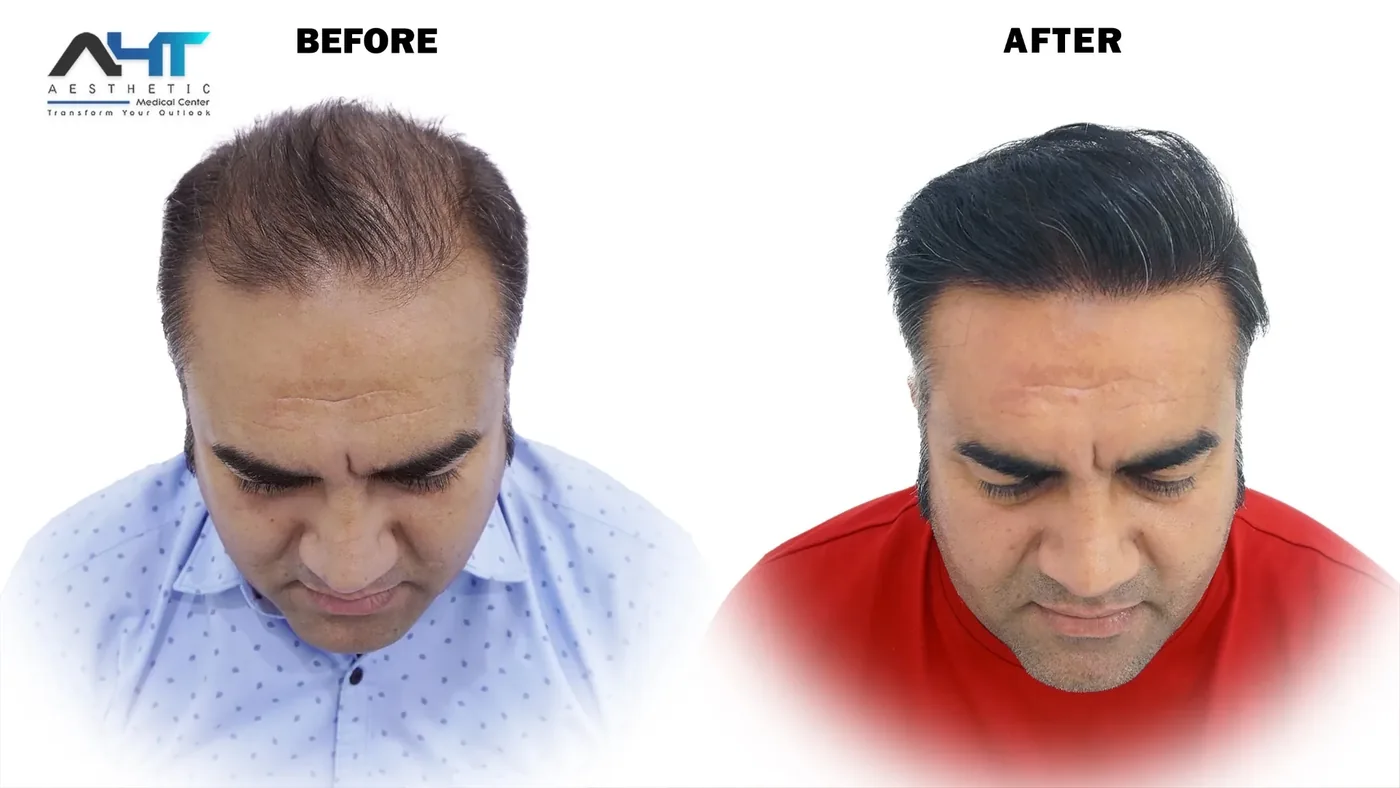 AHT Patient Result 10 before and after