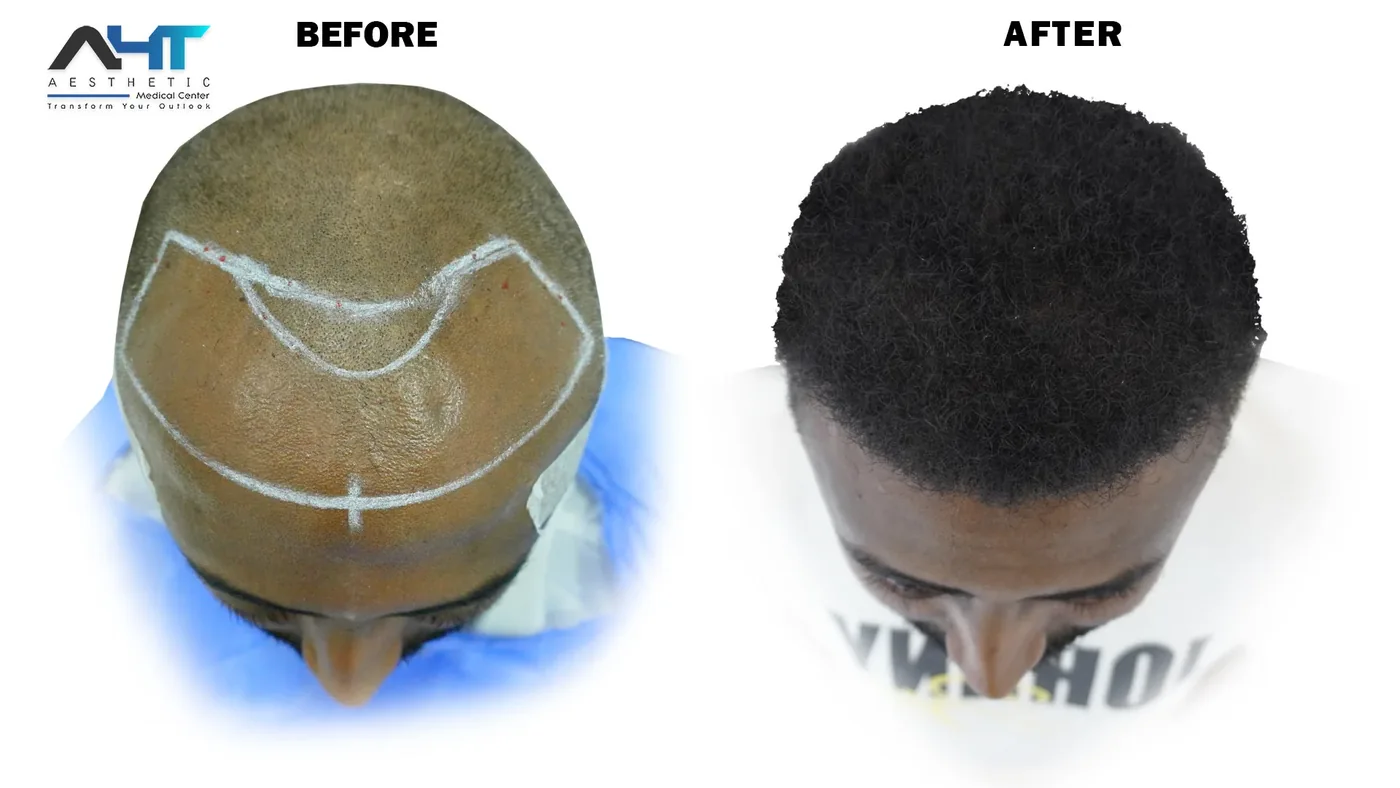 AHT real patient hair transplant result 5