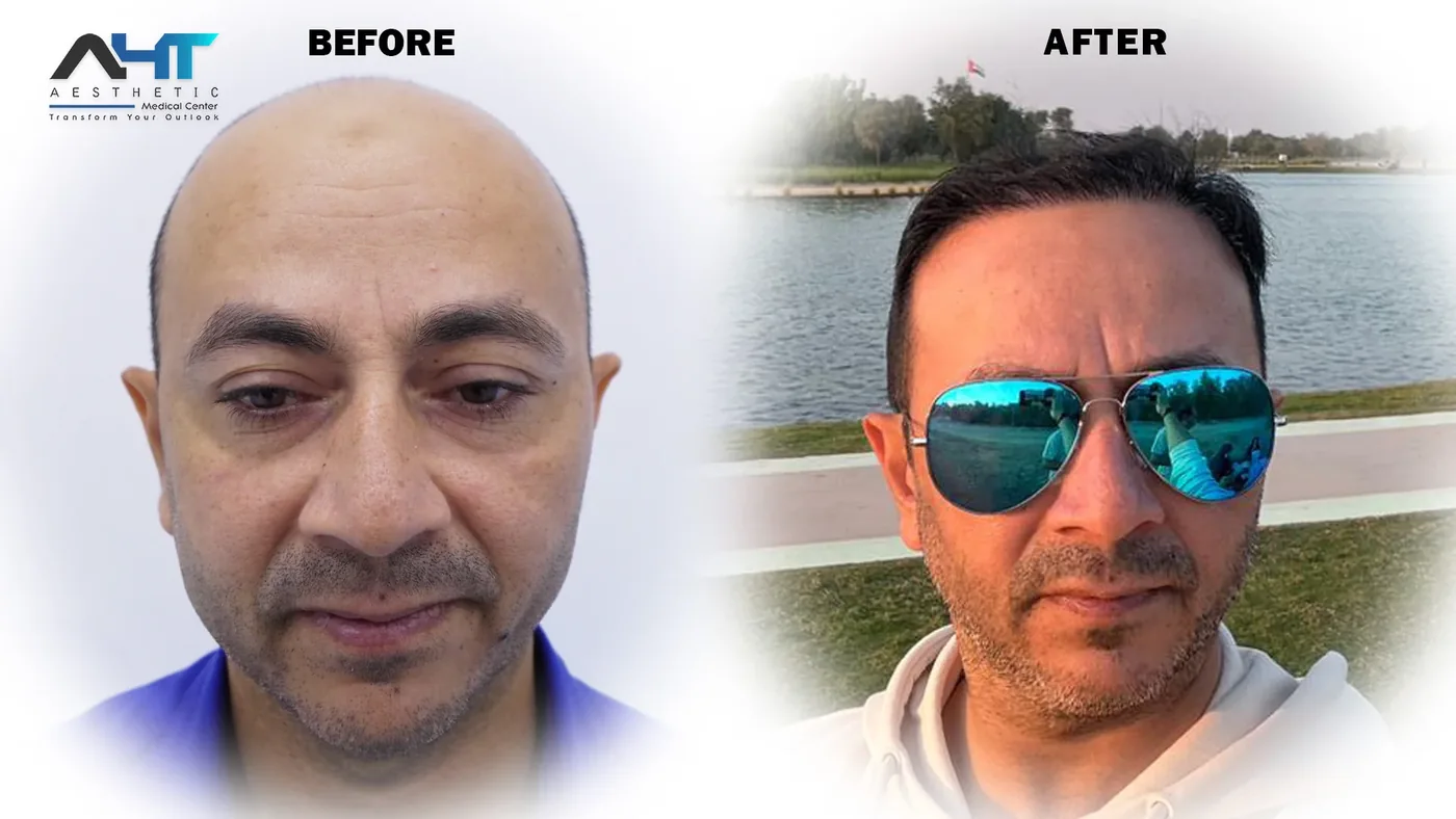 AHT real patient hair transplant result 8