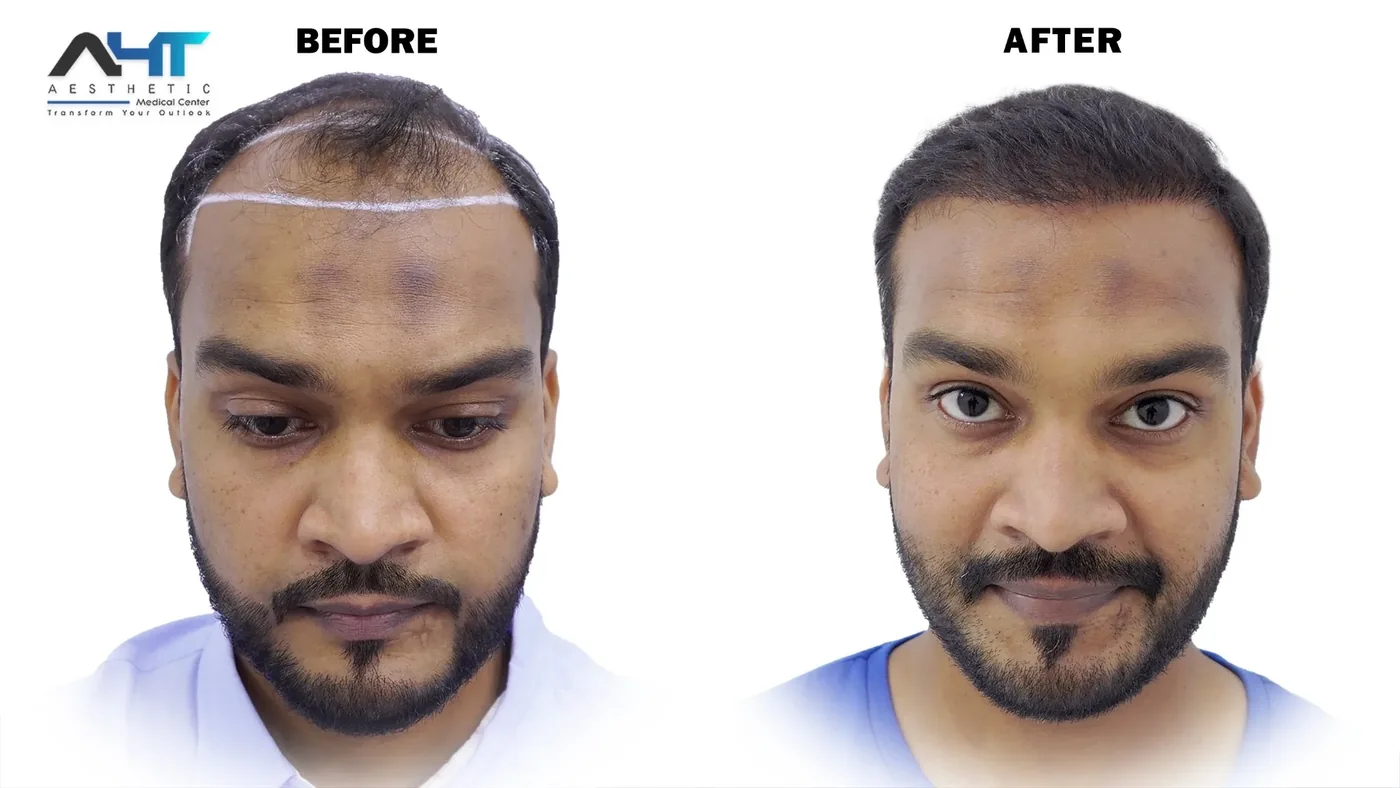 AHT real patient hair transplant result 9