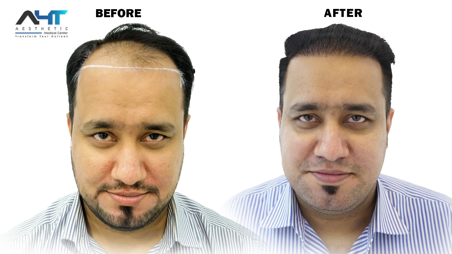 AHT real patient hair transplant result 11