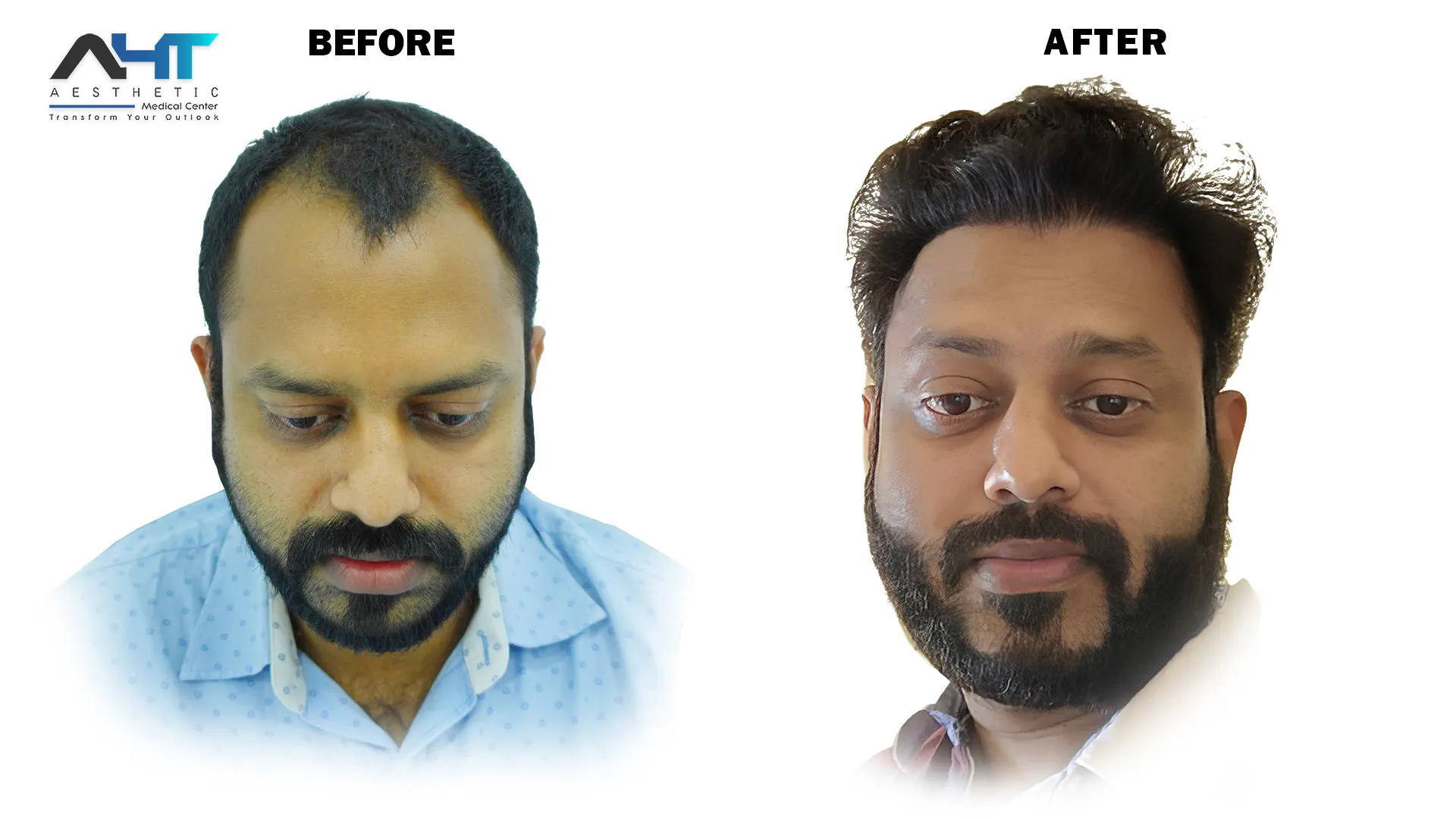 AHT real patient hair transplant result 16