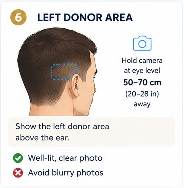 Left Donor Area photo example