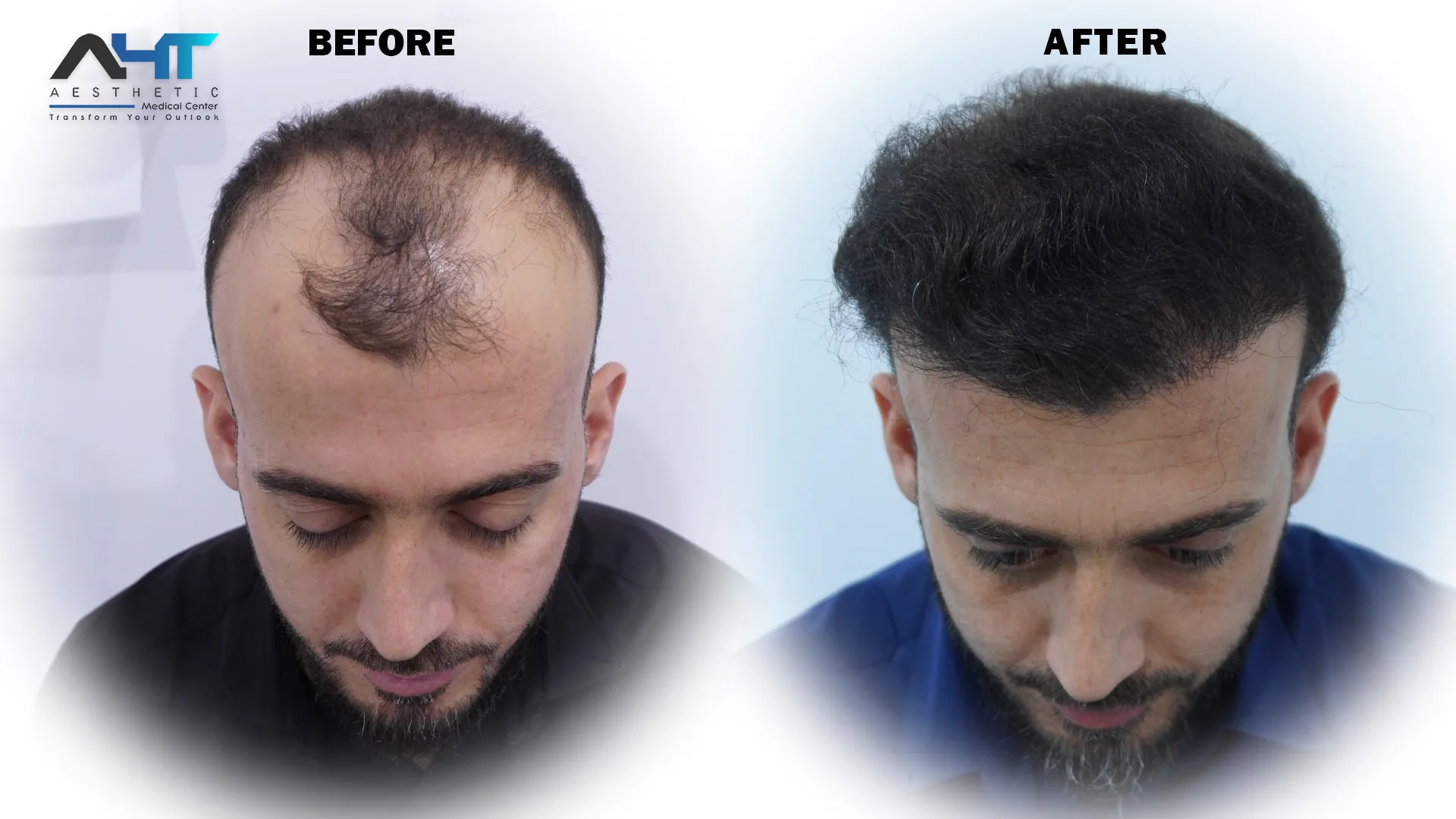 AHT patient hair transplant before and after result 1