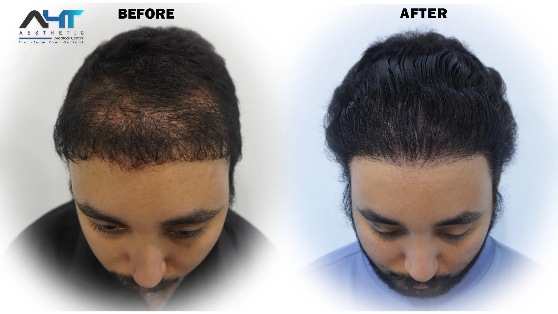 AHT patient hair transplant before and after result 4