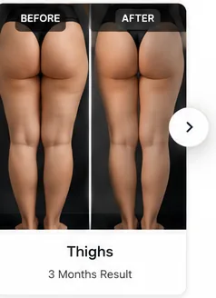 Post-Weight-Loss Contour tummy tuck before and after illustrative example