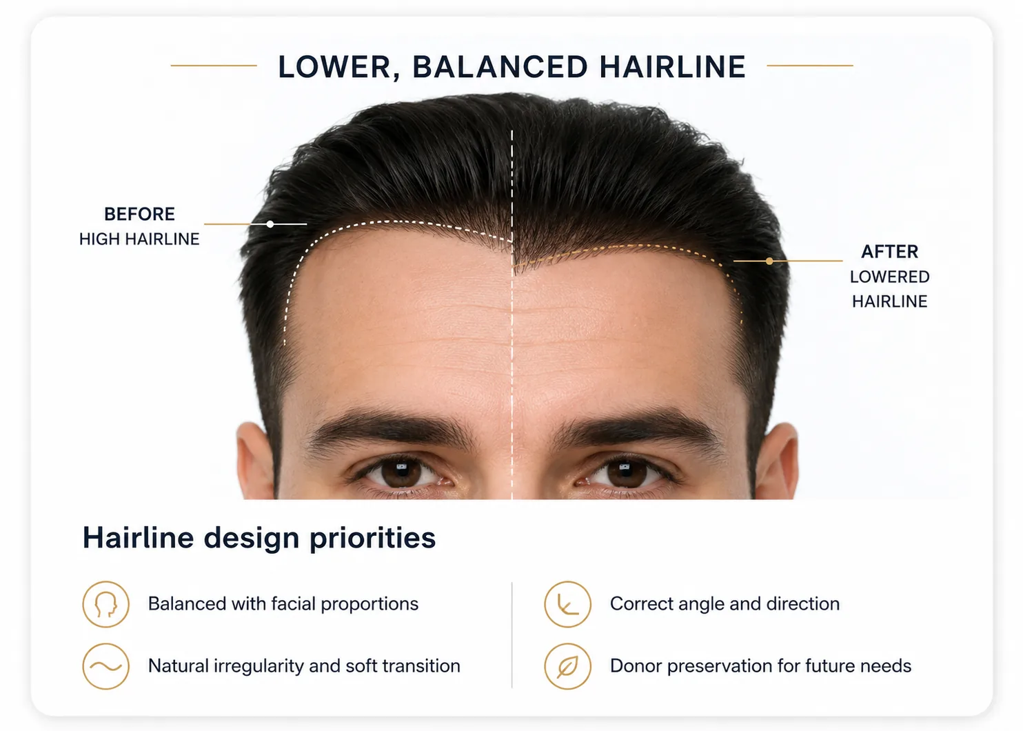 Hairline lowering before and after design guide